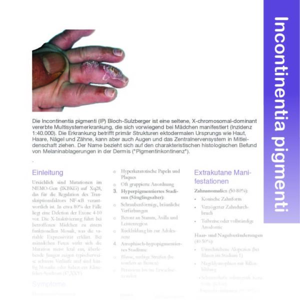 Incontinentia pigmenti (IP) Bloch-Sulzberger