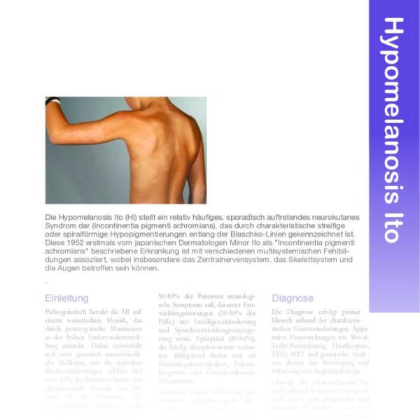 Hypomelanosis Ito