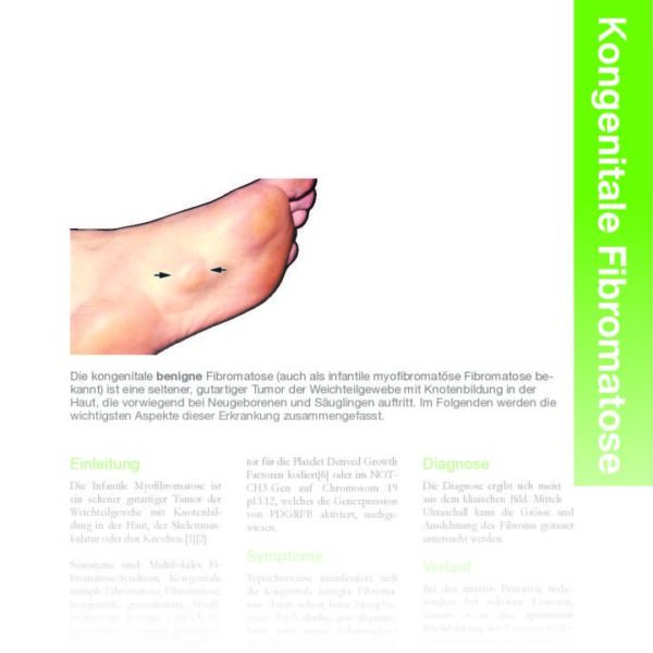 Kongenitale benigne Fibromatose