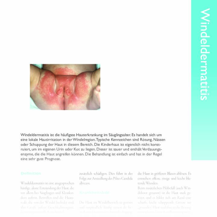 Windeldermatitis - Paediatrieinfo